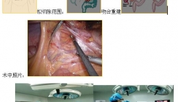 我院成功开展首例腹腔镜下右半结肠癌根治术
