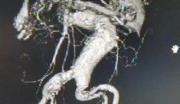 【开平市首例】我院成功完成腹主动脉瘤腔内治疗手术