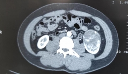 开平市中心医院成功开展高难度腹腔镜下肾部分切除术
