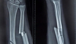 桡尺骨骨折健康教育(上)--饮食