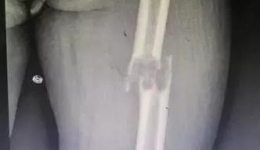 长肿瘤的骨头被切除怎么办？外二科这次亮出了黑科技...