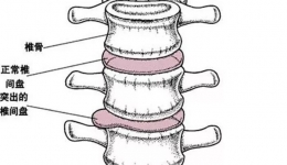 腰痛腿麻！中医理疗选哪个？！--腰椎保健专题(二)