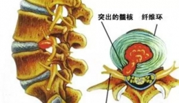 腰痛腿麻?当心腰椎间盘突出！--腰椎保健专题（一）