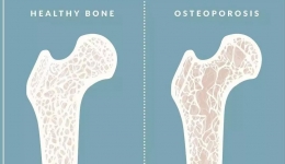 骨质疏松怎么办？腰酸背痛看这里！