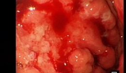 ​【小切口，大能耐】开平市中心医院外五科完成一例完全腹腔镜根治性全胃切除+D2淋巴结清扫术