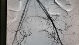 【开平首例】微创血管介入治疗，产后出血“克星”