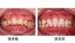 洗牙是智商税吗？洗牙到底是有利还是有害？——— 定期洗牙：让你的口腔更加健康