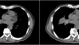 开平市中心医院成功完成一例高难度气管镜下异物取出术、肉芽组织高频电切术