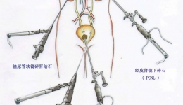 【医学科普】疯狂的“石头”——泌尿系结石