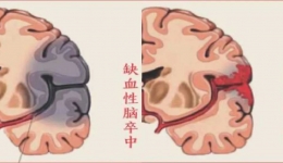 【卒中科普知识系列一】识别脑卒中
