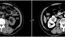 【医学科普】肾癌：悄然来袭的“沉默杀手”