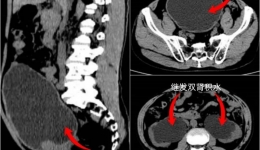 【医学科普】不容忽视的中老年男性健康问题：前列腺增生（二）
