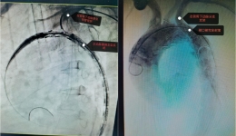 开平首例！市中心医院 “拆弹” 成功 —— 分体式支架精准破解 Stanford B 型主动脉夹层，这些高危人群要警惕！