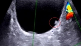 [医学科普]只因体检多扫这一眼，这位市民揪出了膀胱里面的“隐形杀手”