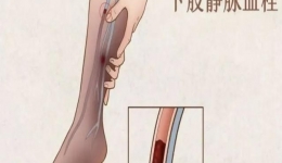 健康科普|沉默的杀手—深静脉血栓