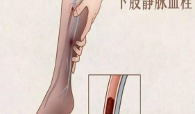 健康科普|沉默的杀手—深静脉血栓