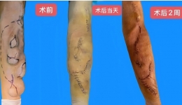 “生命线”告急！五处血管瘤+内瘘失功，开平医护一台手术“双杀”破局